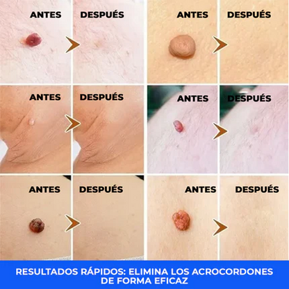 El Eliminador Definitivo de Verrugas - DermaZero + 1 GRATIS